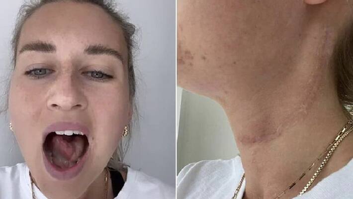 woman lost a part of her tongue as cancer diagnosis took time woman lost a part of her tongue as cancer diagnosis took time