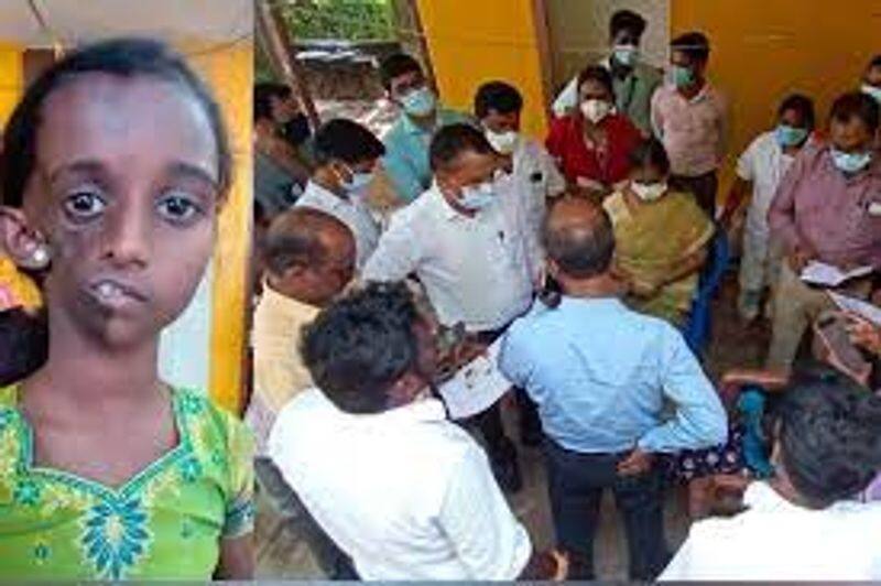 A girl suffering from a rare type of facial disfigurement underwent surgery - CM Order 