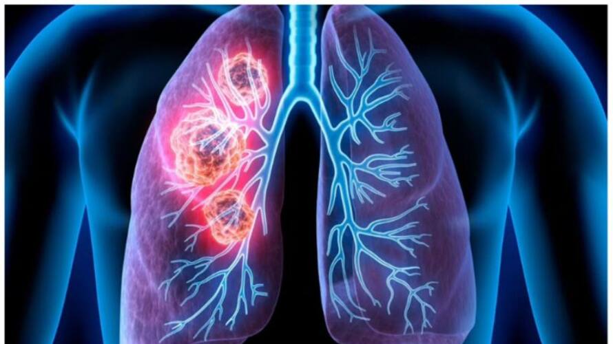 world cancer day first signs of lung cancer res world cancer day first signs of lung cancer res