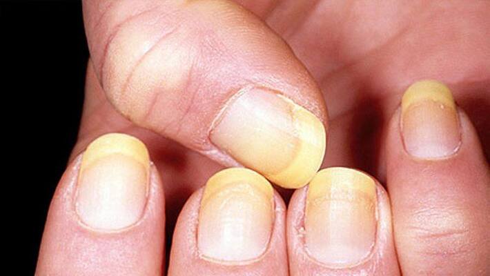 Lung cancer Don't ignore this symptom in your nails Lung cancer Don't ignore this symptom in your nails