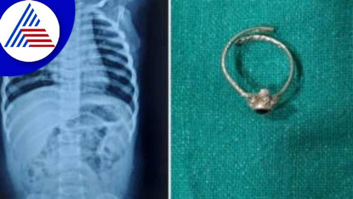 Baby Swallowed Toe Ring Of Mother In Maharastras Bharamathi Vin Baby Swallowed Toe Ring Of Mother In Maharastras Bharamathi Vin