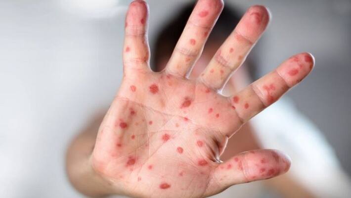 Tomato flu spreading in India Symptoms and treatment vva Tomato flu spreading in India Symptoms and treatment vva