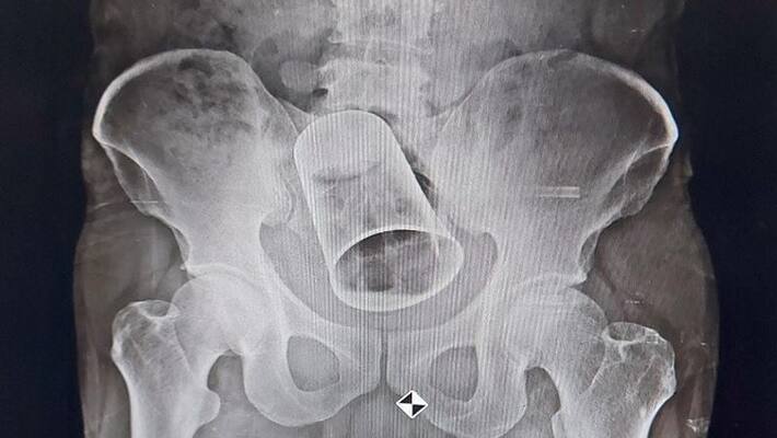 Steel glass inserted inside man private parts by friends removed surgically after 10 days vva Steel glass inserted inside man private parts by friends removed surgically after 10 days vva