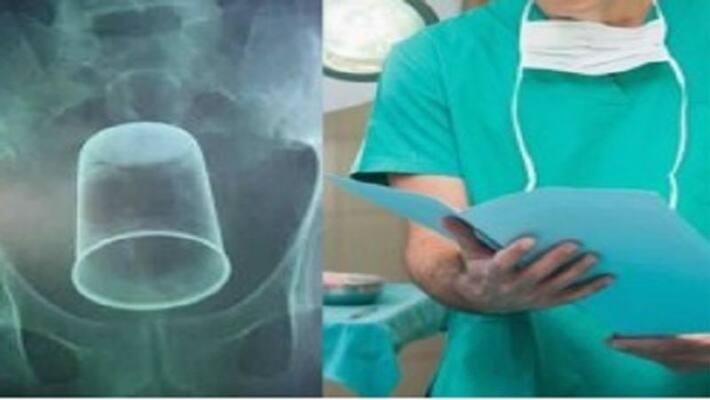 Steel glass inserted inside man private parts by friends Steel glass inserted inside man private parts by friends