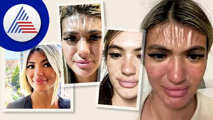 Woman Forehead Skin Looking Like Plastic, She Slept Under Sun Vin Woman Forehead Skin Looking Like Plastic, She Slept Under Sun Vin
