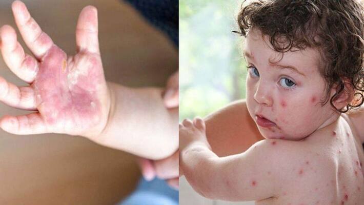 Tomato Flu virus government guidelines know symptoms and treatment NTP Tomato Flu virus government guidelines know symptoms and treatment NTP