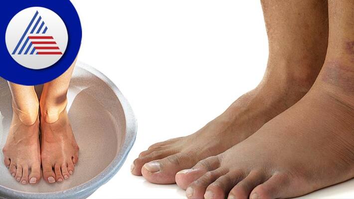 Home Remedies For Foot Swelling home remedies could help you overcome Home Remedies For Foot Swelling home remedies could help you overcome