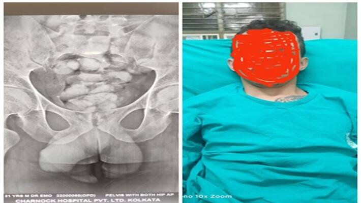 NCB nabbed 44 Drug capsules found in Brazilian young man s body in Kolkata airport NCB nabbed 44 Drug capsules found in Brazilian young man s body in Kolkata airport