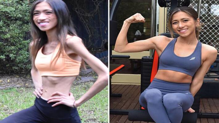 weight loss young girl eating disorder anorexia nervosa after weight just 30 kg NTP weight loss young girl eating disorder anorexia nervosa after weight just 30 kg NTP