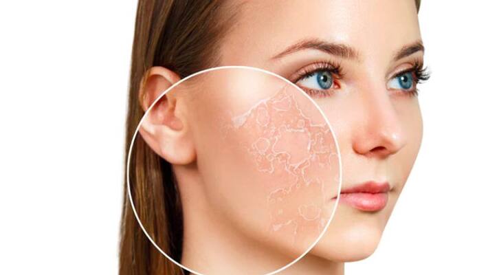 eating and drinking habits that may lead to dry skin eating and drinking habits that may lead to dry skin