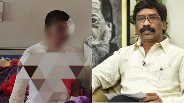 chatra news CM Hemant Soren ordered to shift acid attack victim to delhi using air ambulance for better treatment asc chatra news CM Hemant Soren ordered to shift acid attack victim to delhi using air ambulance for better treatment asc