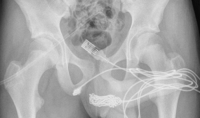 15 year old boy gets usb cable stuck in his penis Doctor removed from surgery NTP
