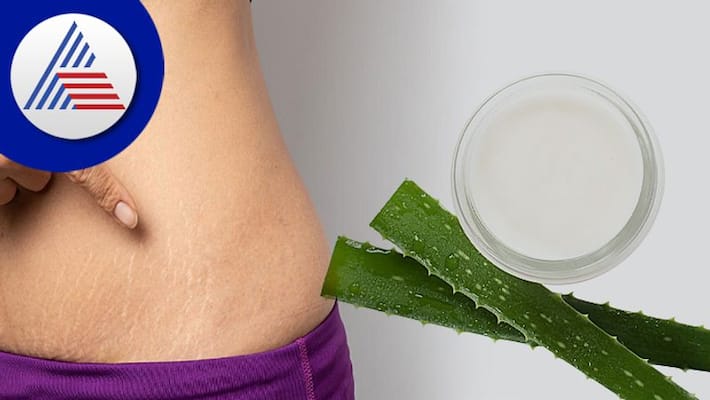 Home Remedies to eradicate Pregnancy Stretch Mark Home Remedies to eradicate Pregnancy Stretch Mark