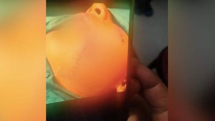 boy attacked by pit bull 200 stitches on his face boy attacked by pit bull 200 stitches on his face