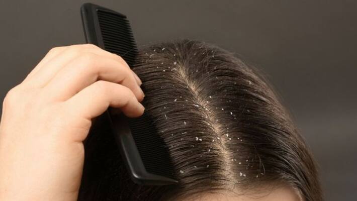 home remedies to get rid of dandruff home remedies to get rid of dandruff
