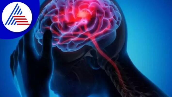 Brain Stroke: Know Its Symptoms, Causes And Prevention Vin Brain Stroke: Know Its Symptoms, Causes And Prevention Vin