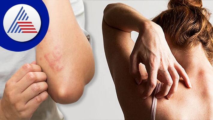 Iitchy and dry skin may be symptom of some diseases Iitchy and dry skin may be symptom of some diseases
