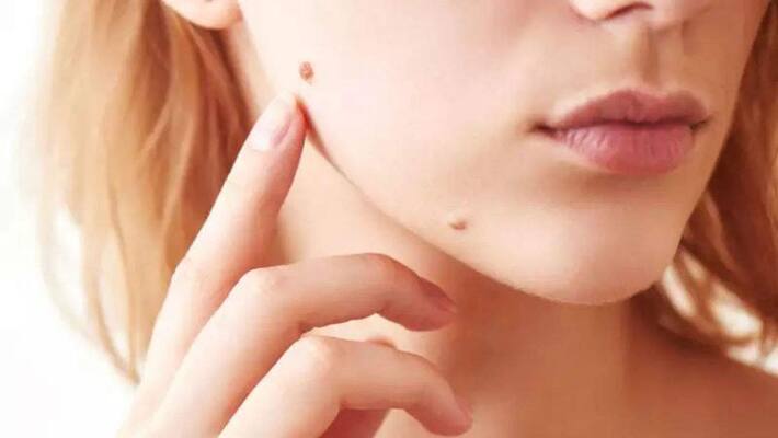 How to remove warts with help of home remedies How to remove warts with help of home remedies