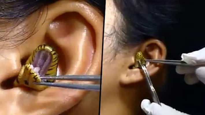 Watch: Snake stuck inside woman's ear: viral video stunned netizens