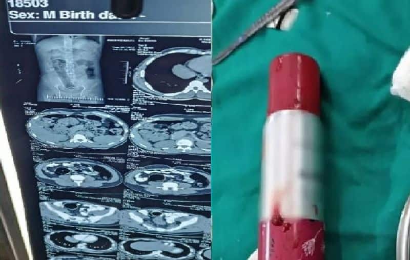 perfume bottle got stuck into young mans stomach and doctors shocked