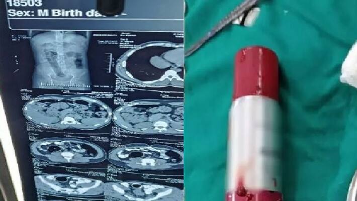 perfume bottle got stuck into young mans stomach and doctors shocked perfume bottle got stuck into young mans stomach and doctors shocked