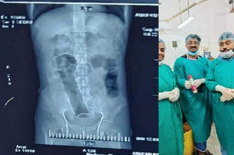 perfume bottle got stuck into young mans stomach and doctors shocked