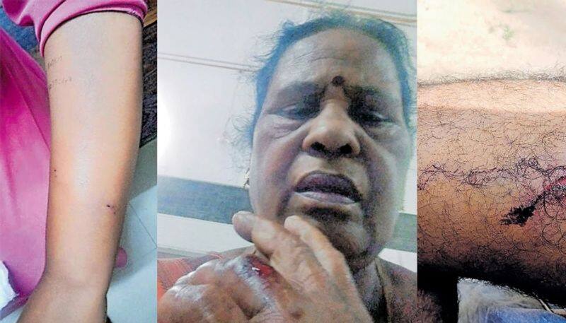 serial actress gets stray dog bite  in thiruvananthapuram 