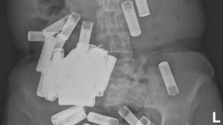 woman swallowed 55 batteries and doctors removed those through surgery woman swallowed 55 batteries and doctors removed those through surgery