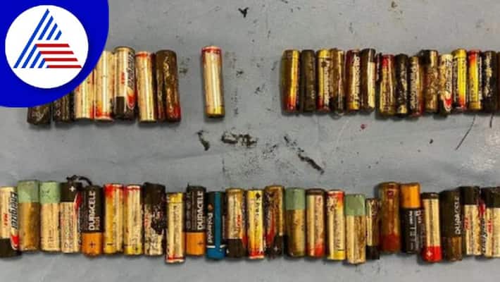 Doctors Remove 55 Batteries From Womans Stomach Vin Doctors Remove 55 Batteries From Womans Stomach Vin