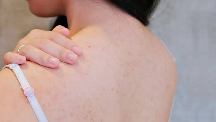 things to do for avoiding acne on back side things to do for avoiding acne on back side