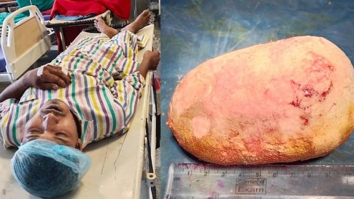 Stone weighing 500 grams in urinary bladder, surgery successful in Jalpaiguri Medical College BSM Stone weighing 500 grams in urinary bladder, surgery successful in Jalpaiguri Medical College BSM