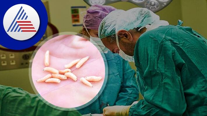 145 Maggots Removed From Womans Eyes And Nose In Bangalore Vin 145 Maggots Removed From Womans Eyes And Nose In Bangalore Vin