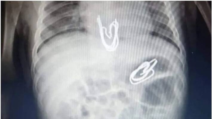 Doctors removed metal clips from babys stomach in Egypt Doctors removed metal clips from babys stomach in Egypt