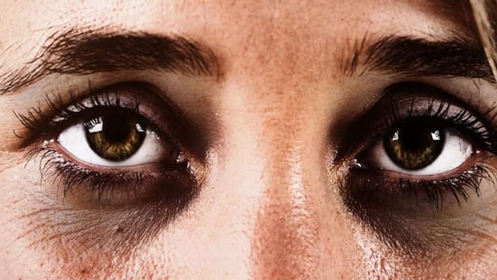 Skin care tips how to get rid from under eye dark circles dva Skin care tips how to get rid from under eye dark circles dva