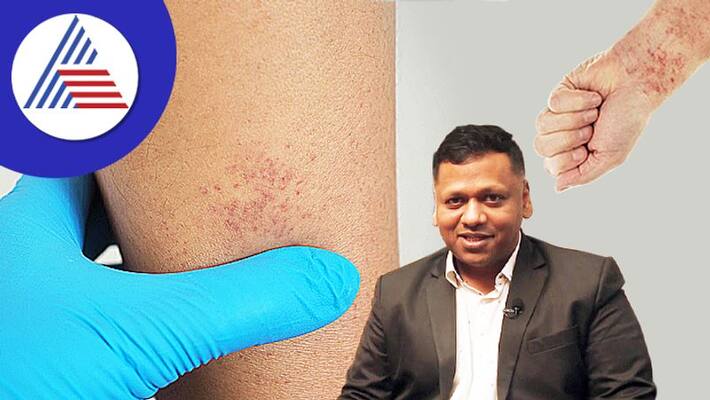 Excessive Bleeding When Injured, Beware This Is Also A Disease Vin Excessive Bleeding When Injured, Beware This Is Also A Disease Vin