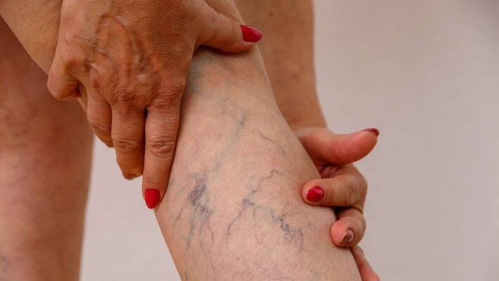 are women more prone to suffer from varicose veins during menopause are women more prone to suffer from varicose veins during menopause