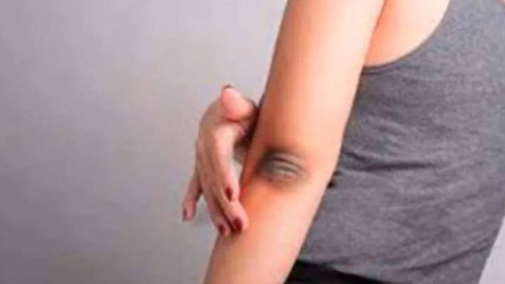 how do you get rid of dark elbows how do you get rid of dark elbows