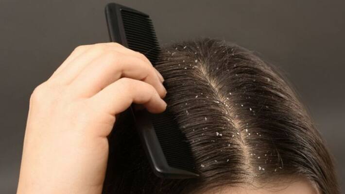 home remedies to treat dandruff and hairfall home remedies to treat dandruff and hairfall