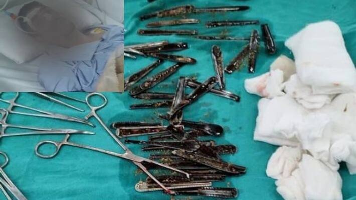 63 Steel Spoons Removed From Man's Stomach In UP 63 Steel Spoons Removed From Man's Stomach In UP