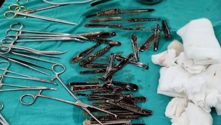 doctors removed 63 spoons from youths stomach doctors removed 63 spoons from youths stomach