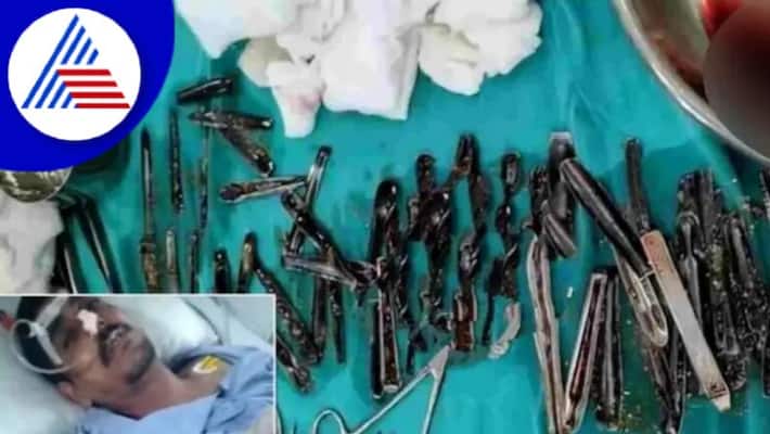 Doctors Remove 63 Spoons From Muzaffarnagar Mans Stomach Vin Doctors Remove 63 Spoons From Muzaffarnagar Mans Stomach Vin