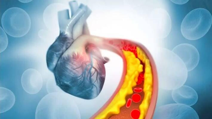 High cholesterol: tips to control cholesterol levels naturally High cholesterol: tips to control cholesterol levels naturally
