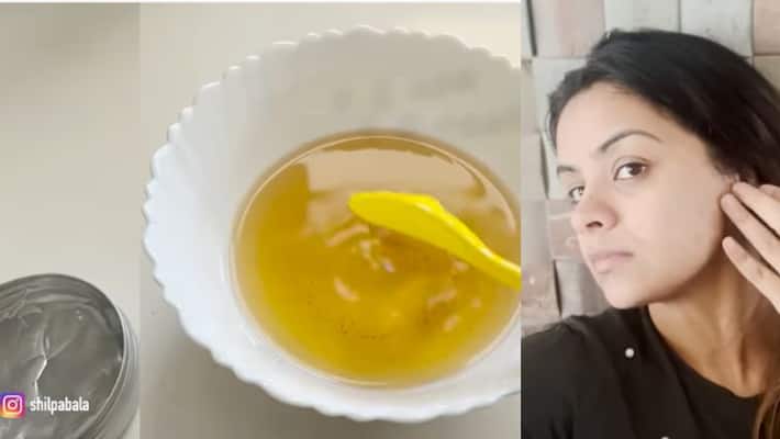 Home Remedies to get rid of Acne by shilpa bala Home Remedies to get rid of Acne by shilpa bala