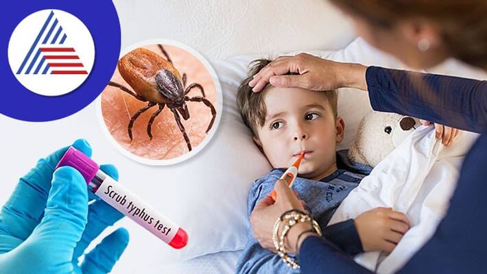 Scrub Typhus Infectious Diseases, Symptoms And Treatments Vin Scrub Typhus Infectious Diseases, Symptoms And Treatments Vin