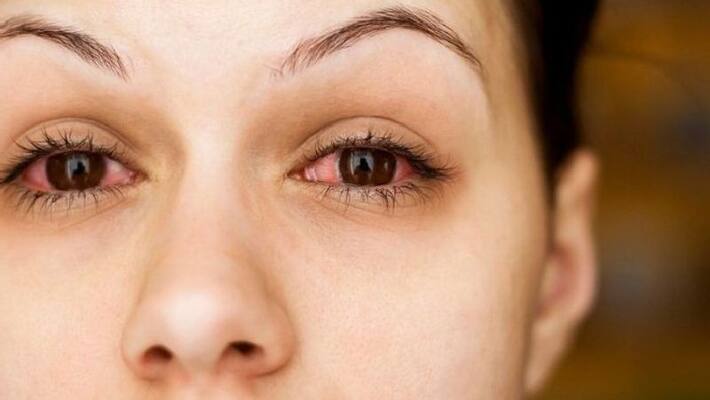here are the five reasons of red eyes here are the five reasons of red eyes