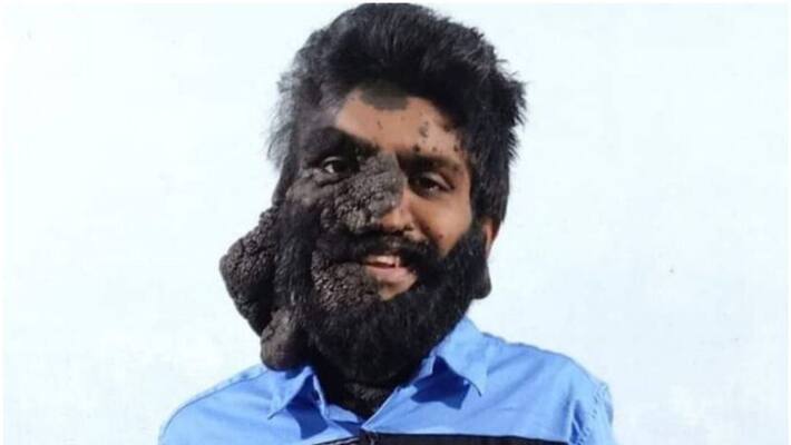 Cancer during rare diseases Prabhulal Prasannan dead Cancer during rare diseases Prabhulal Prasannan dead