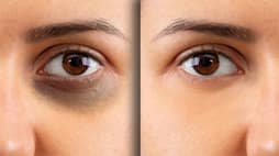natural ways to treat dark circles under the eyes res