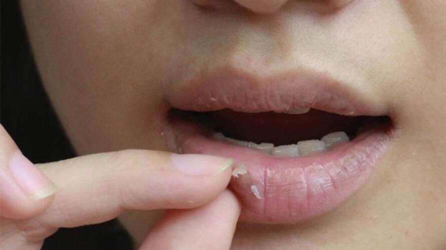common reasons behind chapped lips common reasons behind chapped lips