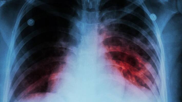WHO report says Tuberculosis deaths and disease increase during the COVID-19 pandemic WHO report says Tuberculosis deaths and disease increase during the COVID-19 pandemic