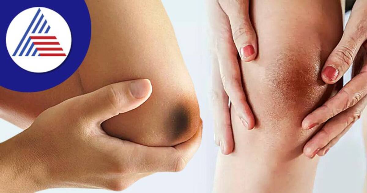 அச்சோ! முழங்கைகள் கருப்பா இருக்கேனு கவலைப்படுறீங்களா? வெள்ளையாக மாற்ற இதோ சூப்பர் டிப்ஸ்!!